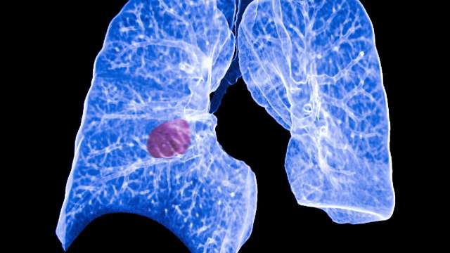 Lung Screening
