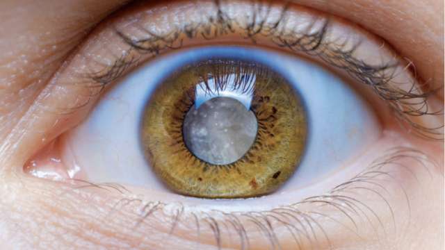 cataract eye cloudy lens