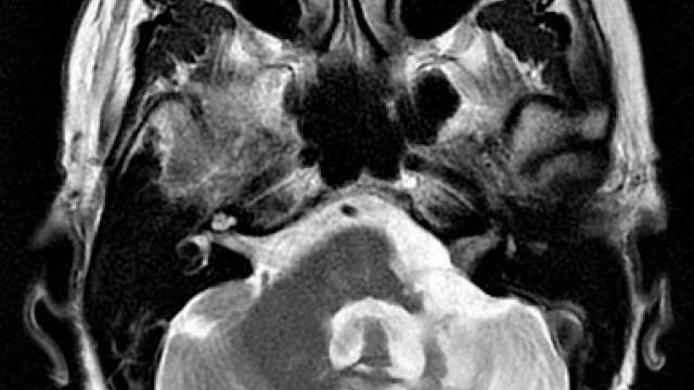 Acoustic neuroma is a rare noncancerous tumor.