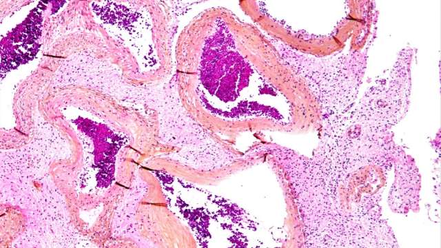 Arteriovenous Malformation (AVM)