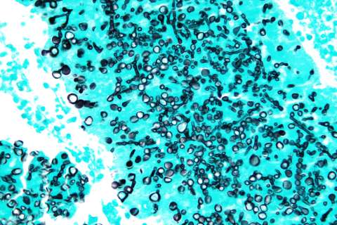 Very high magnification micrograph of coccidioidomycosis, also known as valley fever and California disease.
