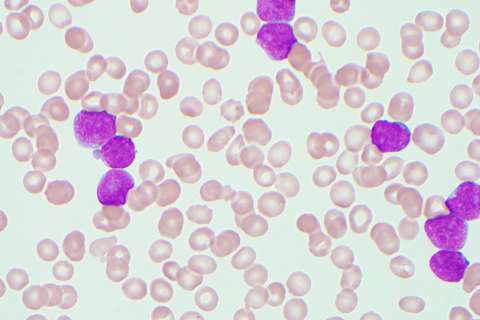 B-lymphoblastic leukemia cells