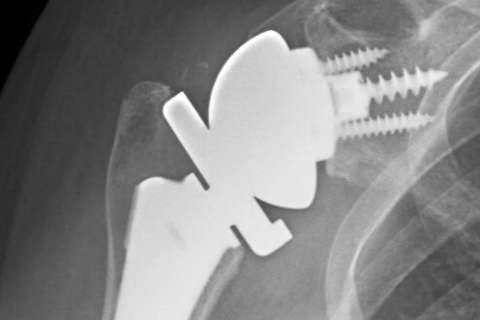 Post-operative X-ray of a reverse shoulder replacement. (Image: Courtesy of Dr. Andrew Jensen)