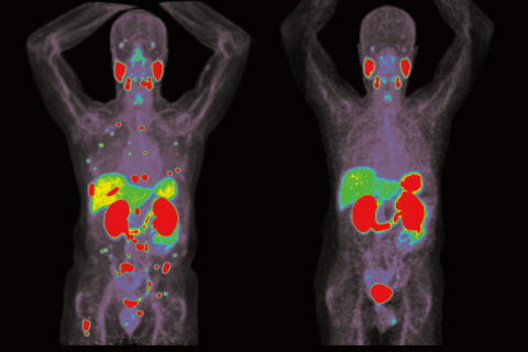 Theranostics cancer treatments scan. Targeted radioactive drugs are used to treat patients with advanced prostate, thyroid and neuroendocrine cancer.