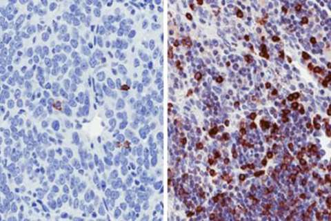  Nanoparticle drug carrier delivering doxorubicin and indoximod 