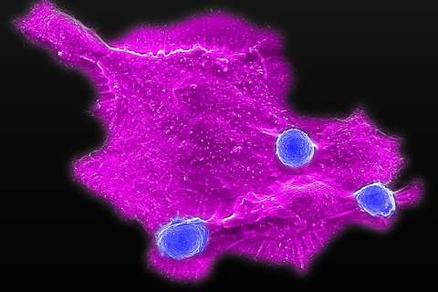 Microscopy image showing blood stem cell-engineered CAR-NKT cells (blue) attacking a human solid tumor cell (magenta)