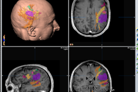 Scans showing tumors and areas of the brain