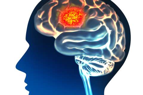 Graphic of glioblastoma