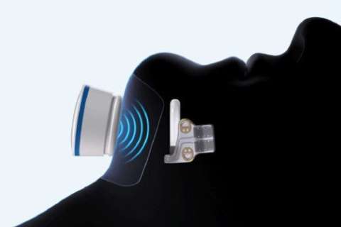 The newest sleep apnea device implanted in the body.