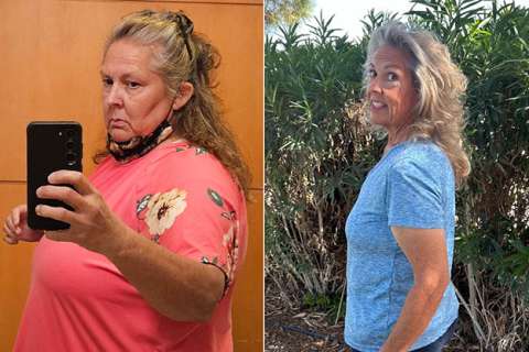 Ruth before and after Gastric Sleeve Surgery at UCLA.