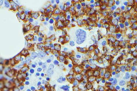 IGF2BP3 IHC performed on a B-ALL case; the blasts are positive and the normal hematopoietic cells are negative.
