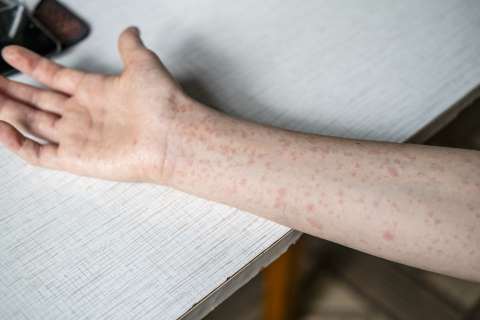 Measles rash on boy's arm.