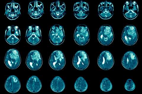 Magnetic resonance imaging Finding 5 cm isodense mass with ill-defined margin and surrounding edema at Left frontal lobe.