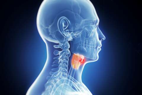 throat tumor illustration