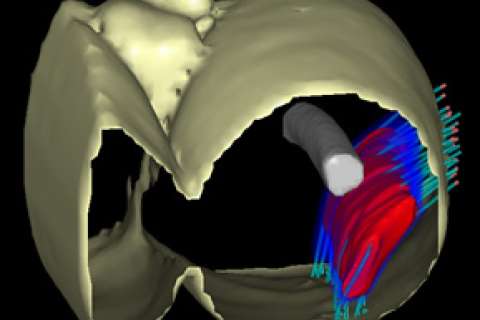 UCLA brachytherapy soft tissue sarcoma