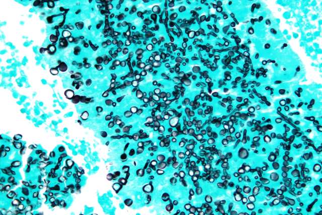 Very high magnification micrograph of coccidioidomycosis, also known as valley fever and California disease.