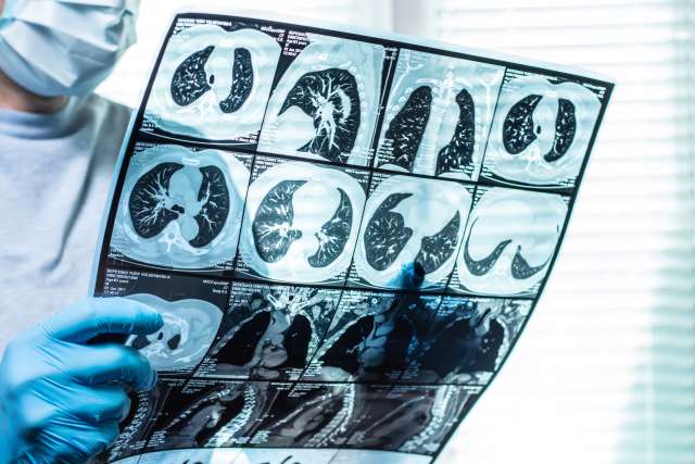 Doctor wearing gloves and a mask examines a series of chest CT scans showing detailed images of the lungs.