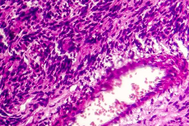 Image of sarcoma cancer cells