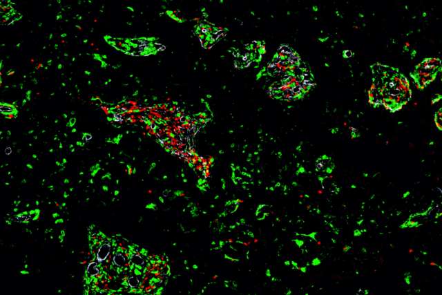 glioblastoma cells