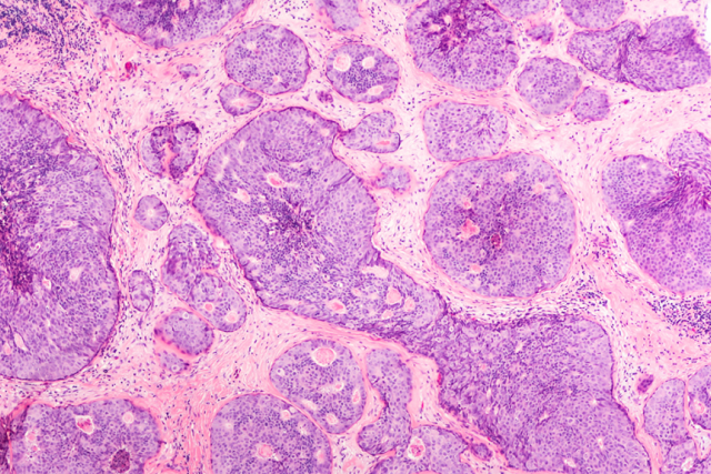 Microscopic image of breast cancer cells