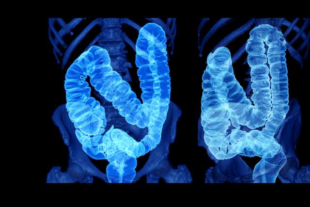 3D image of a colorectal cancer screening