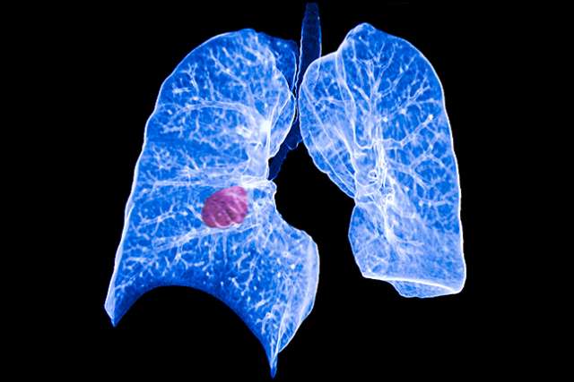 Medical scan showing a pair of lungs in blue with a highlighted pink mass on the left lung, indicating a possible abnormality or tumor.