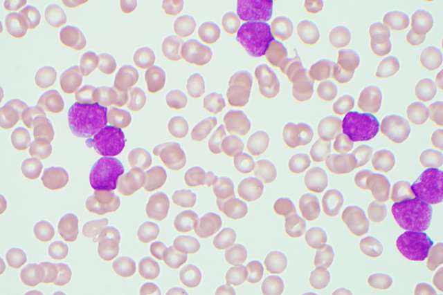 B-lymphoblastic leukemia cells