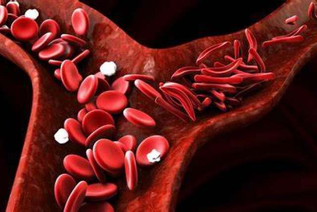 sicklecell