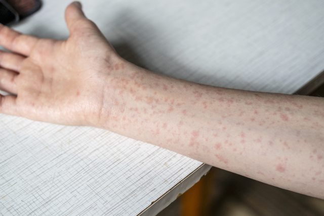 Measles rash on arm