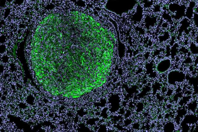 Kidney cancer 