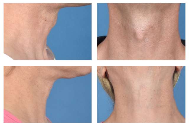 Adam's apple surgery before and after