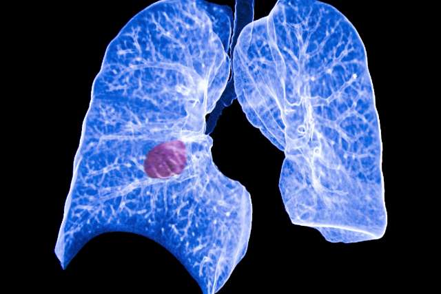 Lung Screening