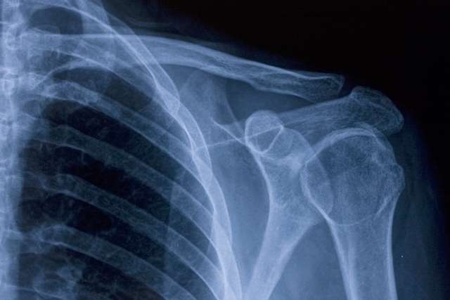Shoulder X-ray.