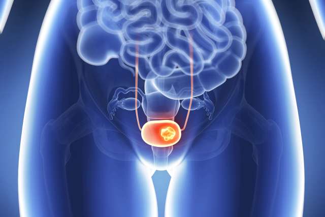 3d rendered illustration - bladder cancer