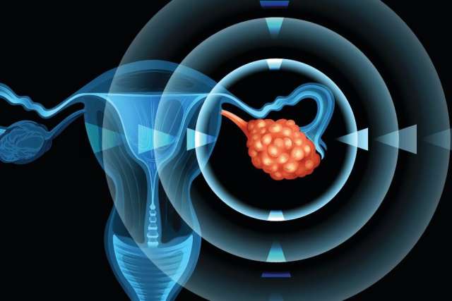 Uterus with highlighted ovarian tumor