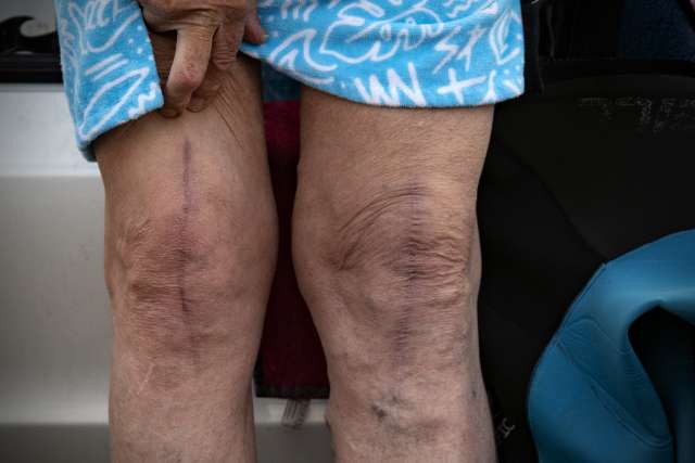 Knee surgery scars