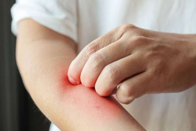 Itching, scratching on arm from insect bite or itchy dry skin eczema dermatitis