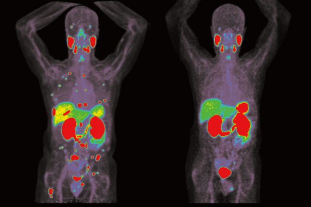 Theranostics cancer treatments scan. Targeted radioactive drugs are used to treat patients with advanced prostate, thyroid and neuroendocrine cancer.