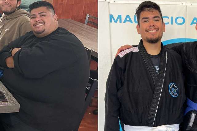 Before and After Gastric Sleeve Surgery