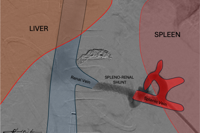 Illustration of a how a spleno_renal shunt works.