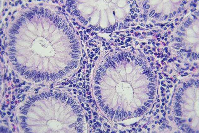 Microscopic image of colon cancer cells