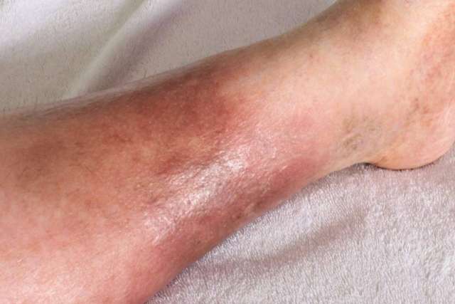 hemosiderin staining