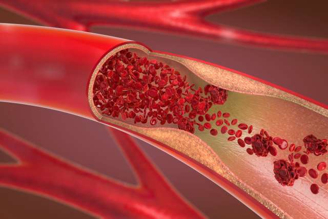 Arteriosclerosis