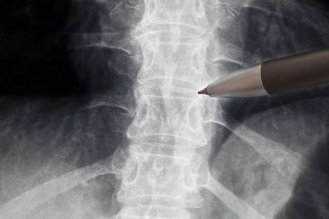 X-ray of a spine