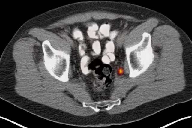 PSMA PET image.