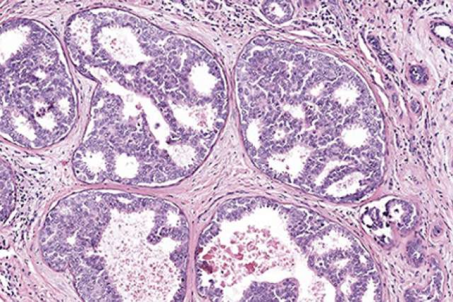 artificial intelligence system that could help pathologists read biopsies more accurately and to better detect and diagnose breast cancer.