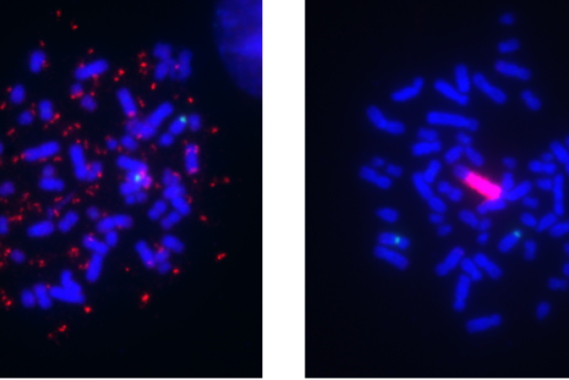 Melanoma cell lines showing gene amplification.Melanoma cell lines can harbor BRAF gene amplification (red signal) in two remarkably different modes, as extrachromosomal DNA (ecDNA) (left) and as an intrachromosomal homogeneously staining region (HSR) (right).