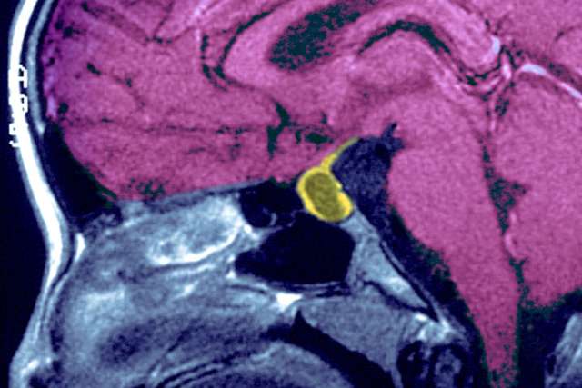 Pituitary Tumor Scan