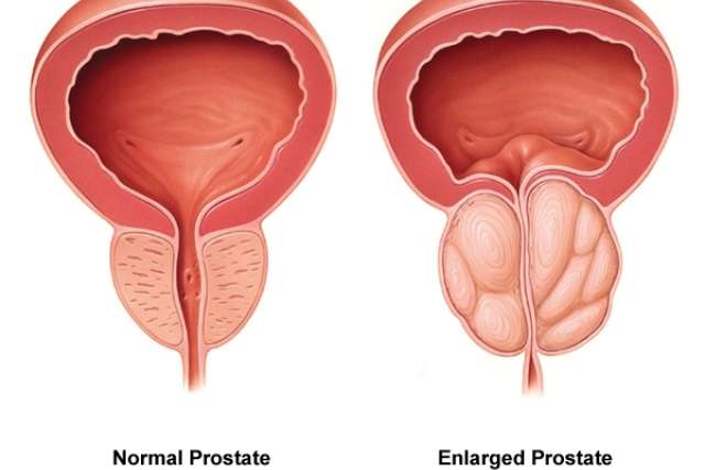 Normal vs. enlarged prostate