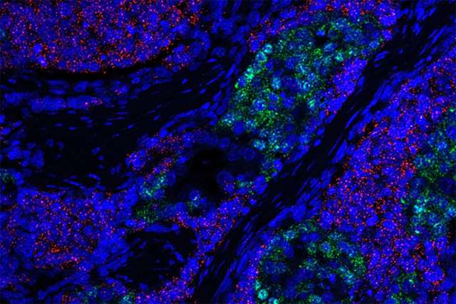 SCN prostate cancer tumor cells